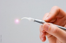 Laser Zahnbehandlung
