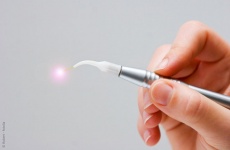 Laser Zahnbehandlung Laser Zahnbehandlung