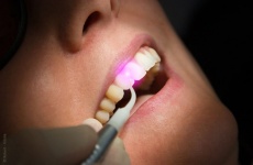 Laserbehandlung Zaehne Laserbehandlung Zaehne